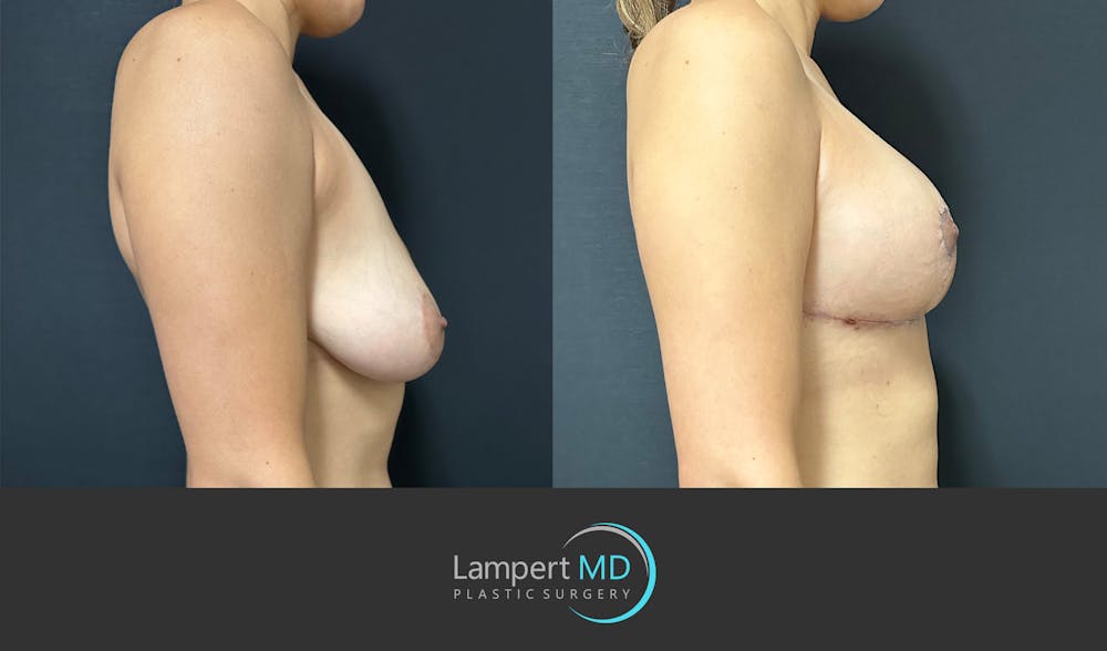 Breast Explant Before & After Gallery - Patient 184652162 - Image 5