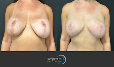 Breast Explant Before & After Gallery - Patient 349226 - Image 1