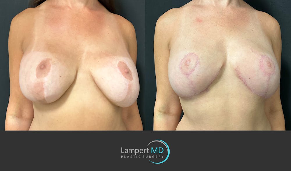 Breast Explant Before & After Gallery - Patient 349226 - Image 2