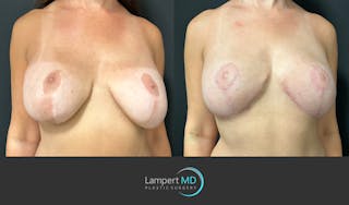 Breast Explant Before & After Gallery - Patient 349226 - Image 2