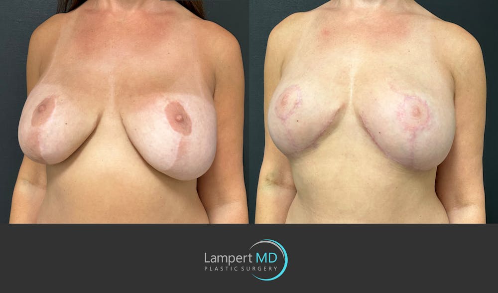 Breast Explant Before & After Gallery - Patient 349226 - Image 3