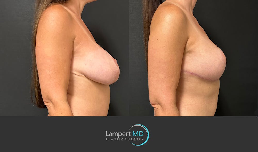 Breast Explant Before & After Gallery - Patient 349226 - Image 4