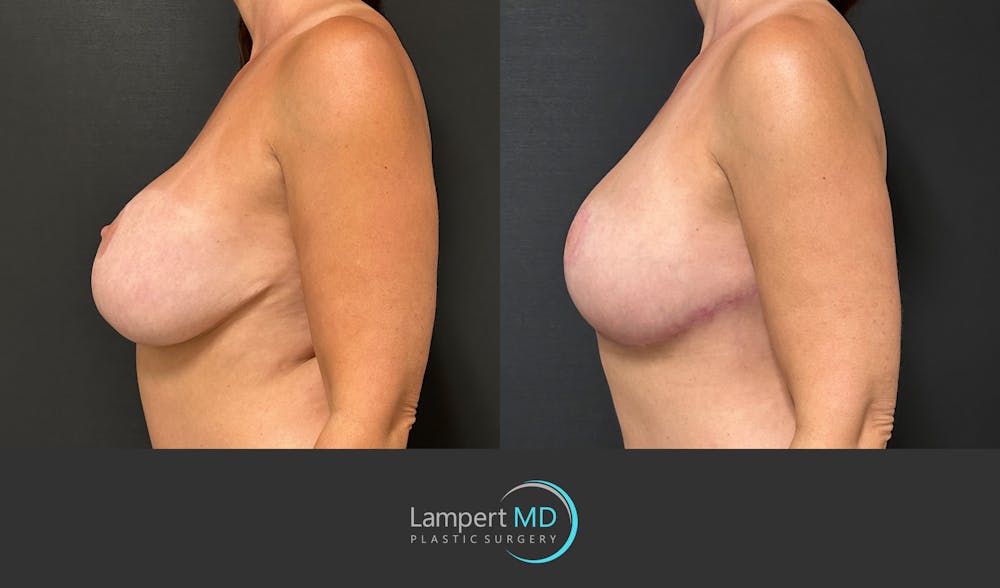 Breast Explant Before & After Gallery - Patient 349226 - Image 5