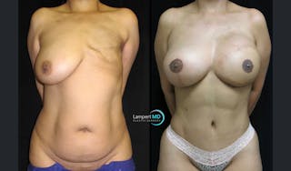 Breast Reconstruction Before & After Gallery - Patient 122909006 - Image 1
