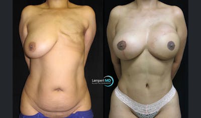 Breast Reconstruction Before & After Gallery - Patient 122909006 - Image 1