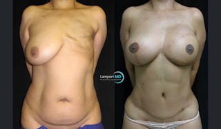 Breast Reconstruction Before & After Gallery - Patient 122909006 - Image 2