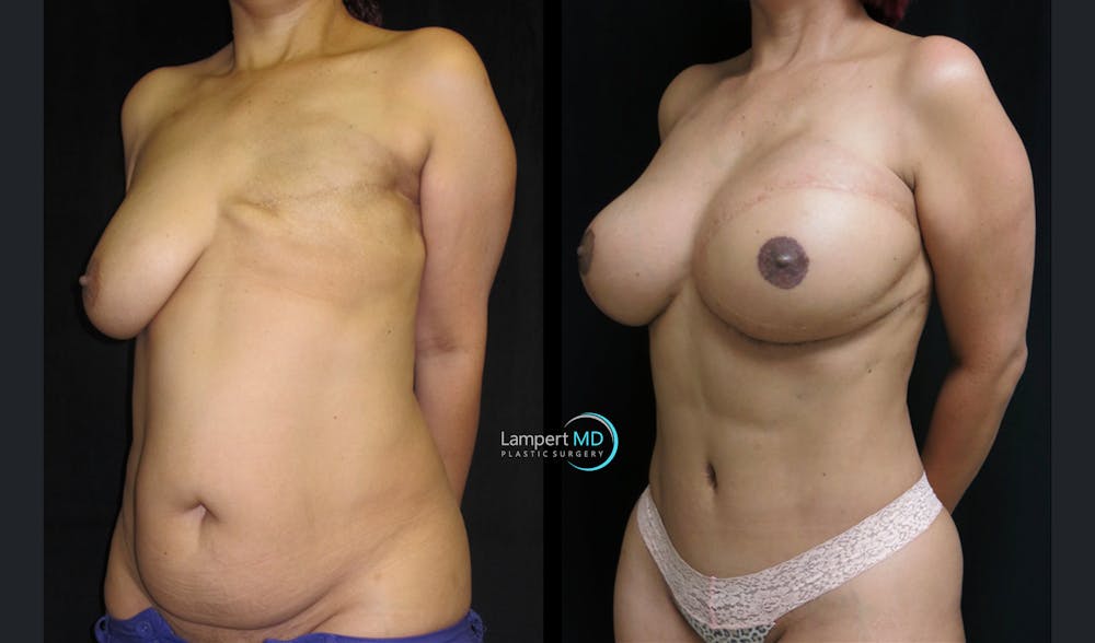 Breast Reconstruction Before & After Gallery - Patient 122909006 - Image 3