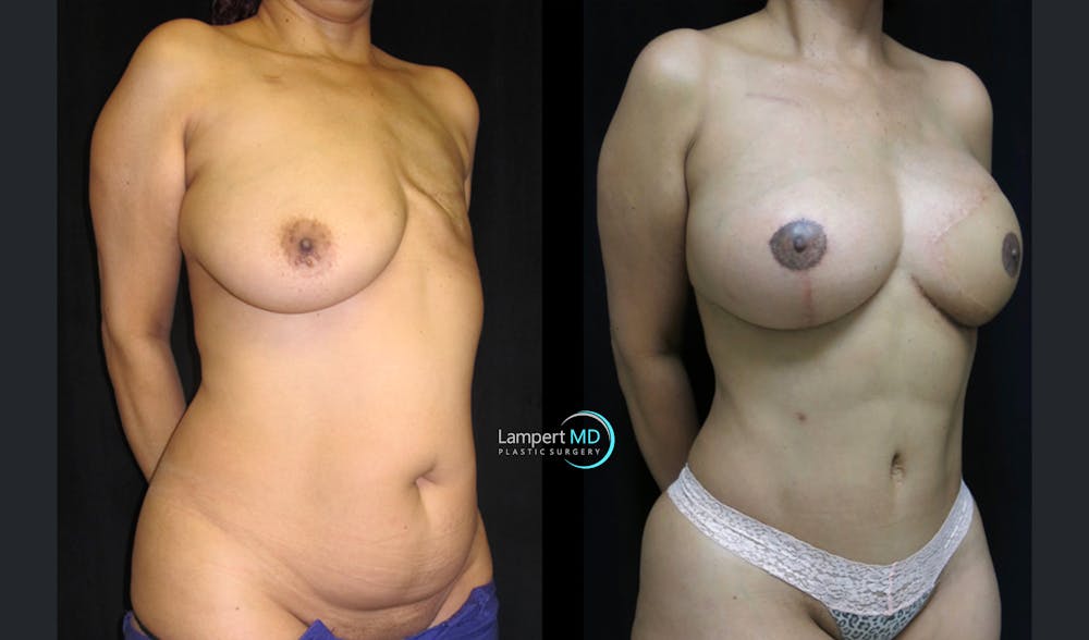 Breast Reconstruction Before & After Gallery - Patient 122909006 - Image 4