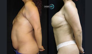 Breast Reconstruction Before & After Gallery - Patient 122909006 - Image 5