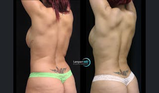 Love Handle Liposuction Before & After Gallery - Patient 922887 - Image 2