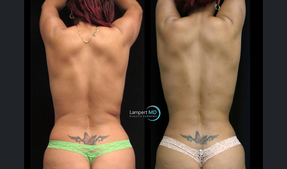 Love Handle Liposuction Before & After Gallery - Patient 922887 - Image 1