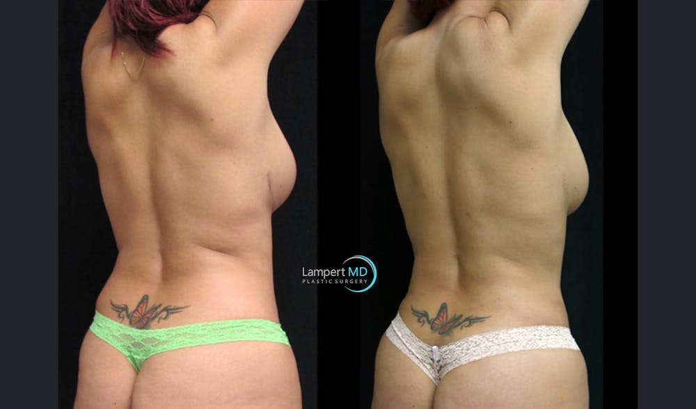 Love Handle Liposuction Before & After Gallery - Patient 922887 - Image 3
