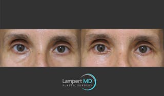 Eyelid Surgery Before & After Gallery - Patient 350031 - Image 1