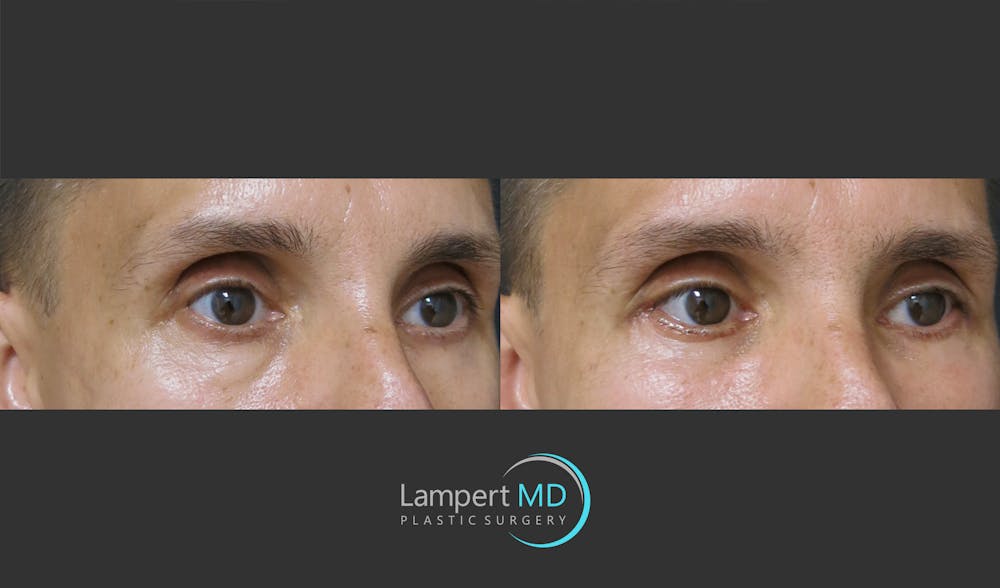 Eyelid Surgery Before & After Gallery - Patient 350031 - Image 2