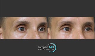Eyelid Surgery Before & After Gallery - Patient 350031 - Image 2