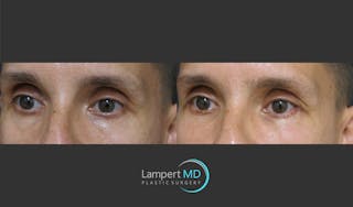 Eyelid Surgery Before & After Gallery - Patient 350031 - Image 3