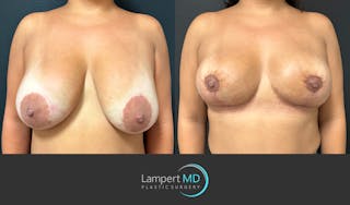 Breast Explant Before & After Gallery - Patient 276775 - Image 1