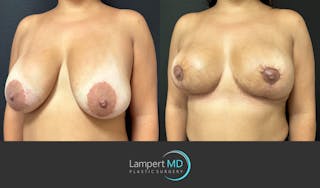 Breast Explant Before & After Gallery - Patient 276775 - Image 2