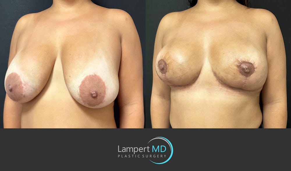 Breast Explant Before & After Gallery - Patient 276775 - Image 2