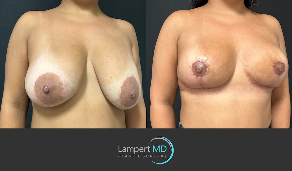 Breast Explant Before & After Gallery - Patient 276775 - Image 3