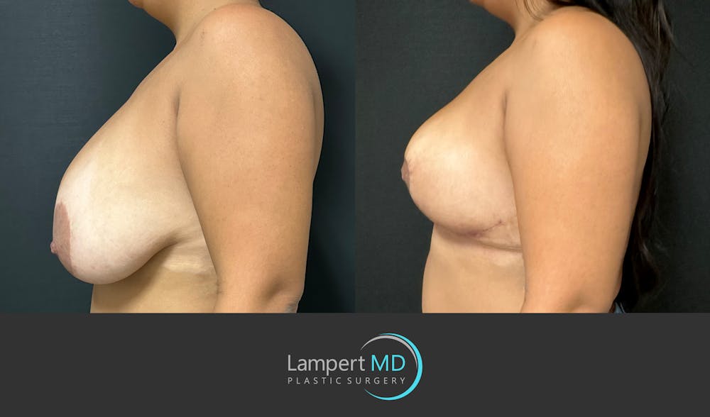 Breast Explant Before & After Gallery - Patient 276775 - Image 4