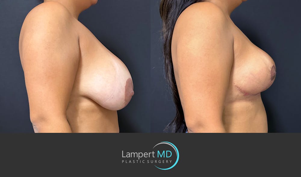 Breast Explant Before & After Gallery - Patient 276775 - Image 5