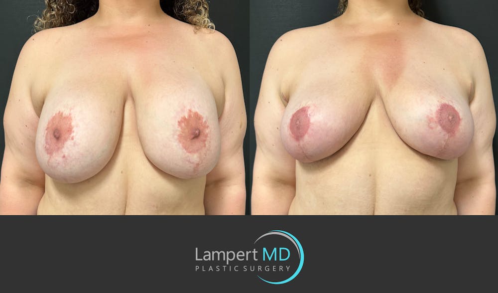 Breast Explant Before & After Gallery - Patient 206257 - Image 1