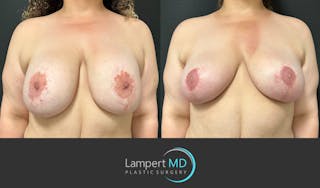 Breast Explant Before & After Gallery - Patient 206257 - Image 1