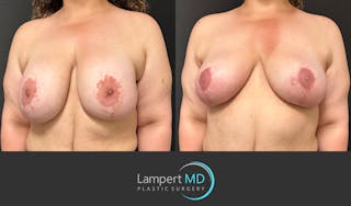 Breast Explant Before & After Gallery - Patient 206257 - Image 2