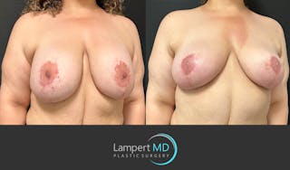 Breast Explant Before & After Gallery - Patient 206257 - Image 3