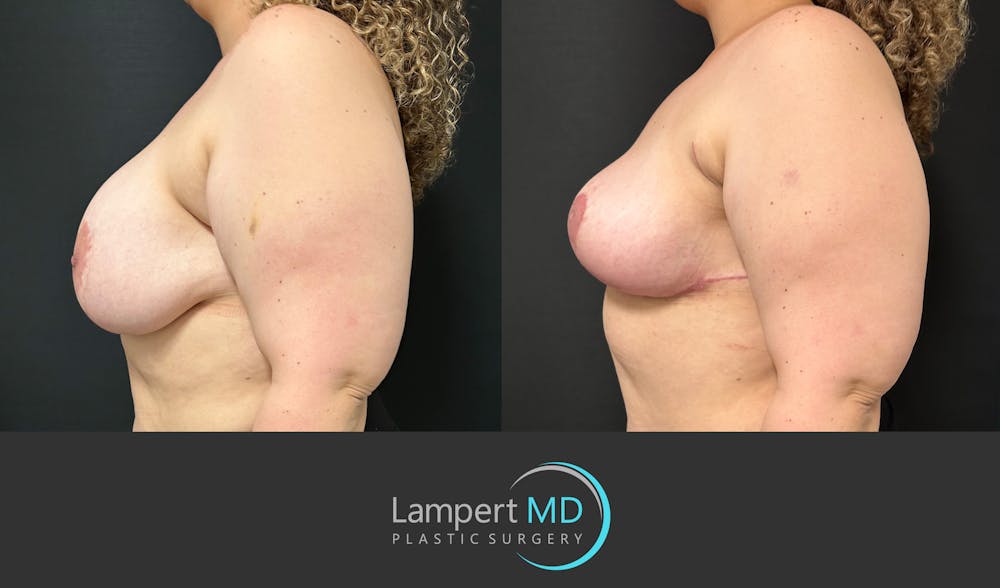 Breast Explant Before & After Gallery - Patient 206257 - Image 4