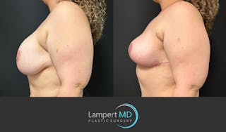 Breast Explant Before & After Gallery - Patient 206257 - Image 4