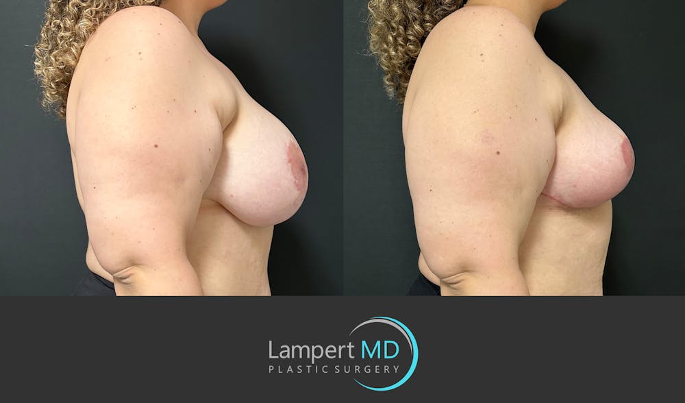 Breast Explant Before & After Gallery - Patient 206257 - Image 5