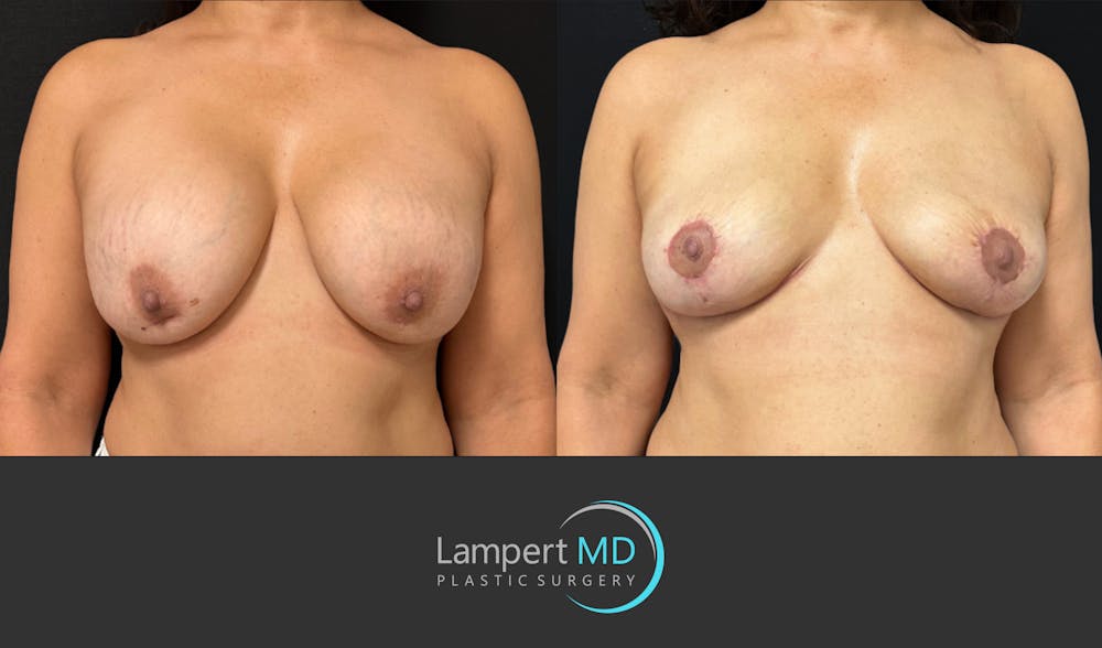 Breast Explant Before & After Gallery - Patient 338880 - Image 1