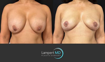 Breast Explant Before & After Gallery - Patient 338880 - Image 1