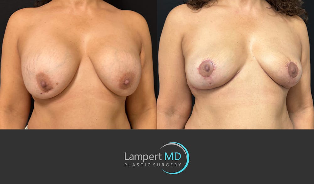 Breast Explant Before & After Gallery - Patient 338880 - Image 2