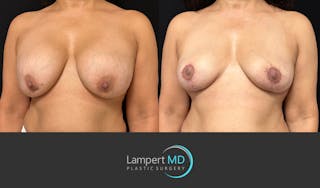 Breast Explant Before & After Gallery - Patient 338880 - Image 3