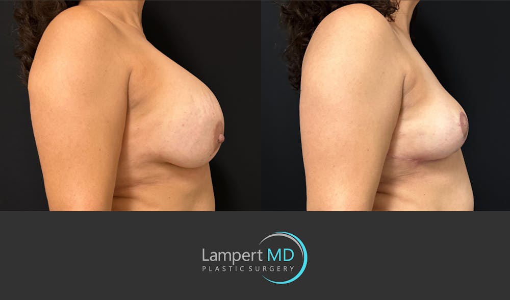Breast Explant Before & After Gallery - Patient 338880 - Image 4