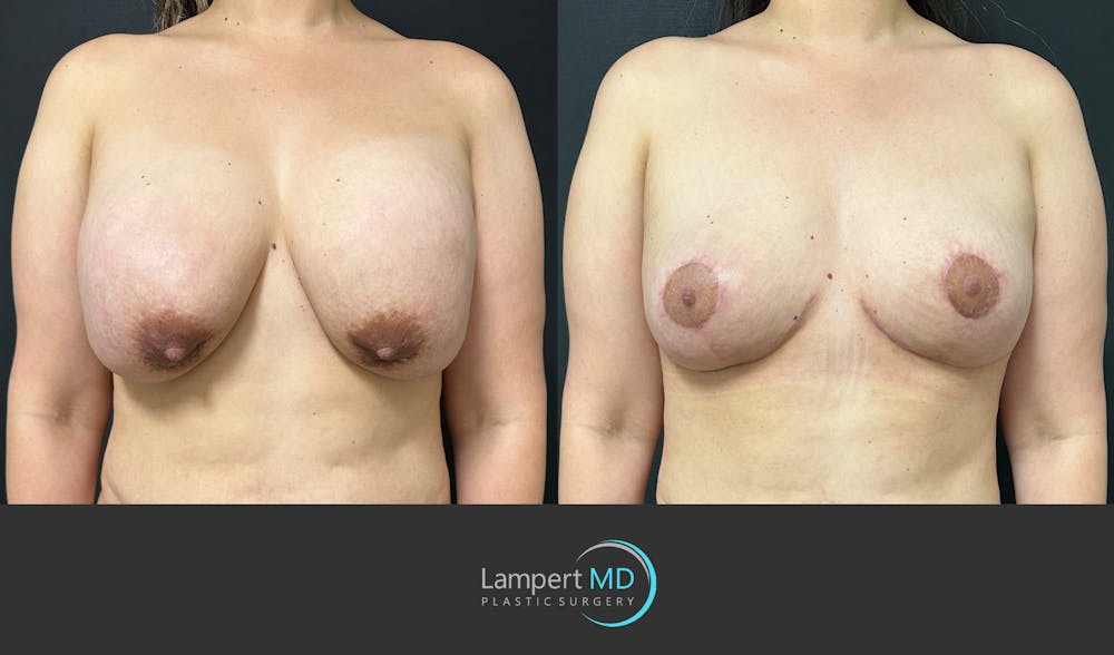 Breast Explant Before & After Gallery - Patient 146131718 - Image 1