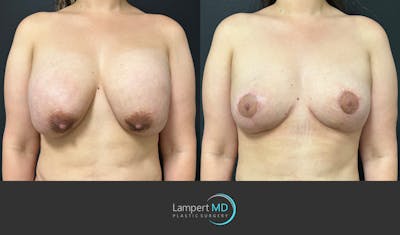 Breast Explant Before & After Gallery - Patient 146131718 - Image 1