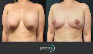 Breast Explant Before & After Gallery - Patient 146131718 - Image 2