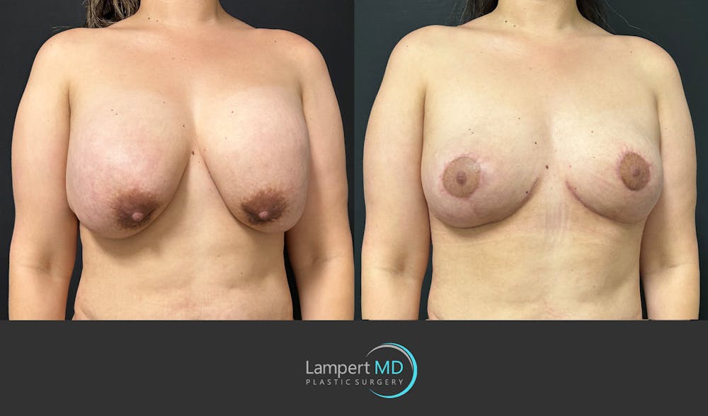 Breast Explant Before & After Gallery - Patient 146131718 - Image 3