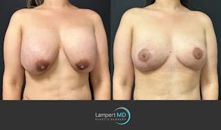 Breast Explant Before & After Gallery - Patient 146131718 - Image 3