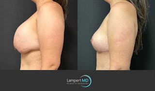 Breast Explant Before & After Gallery - Patient 146131718 - Image 4