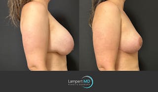 Breast Explant Before & After Gallery - Patient 146131718 - Image 5