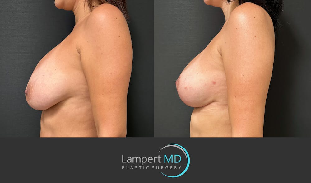 Breast Revision Before & After Gallery - Patient 122908894 - Image 3