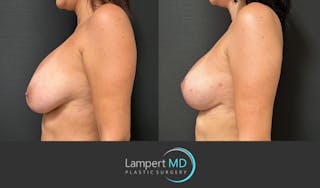 Breast Revision Before & After Gallery - Patient 122908894 - Image 3
