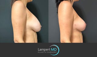 Breast Revision Before & After Gallery - Patient 122908894 - Image 4