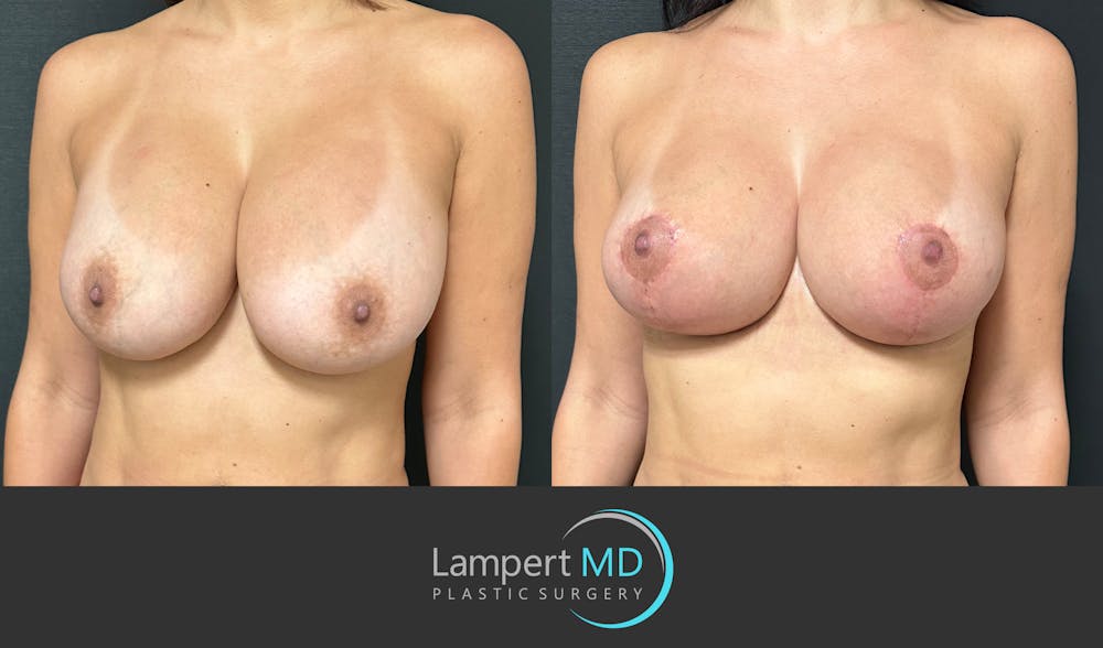 Breast Revision Before & After Gallery - Patient 122908894 - Image 2