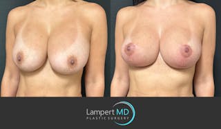 Breast Revision Before & After Gallery - Patient 122908894 - Image 2